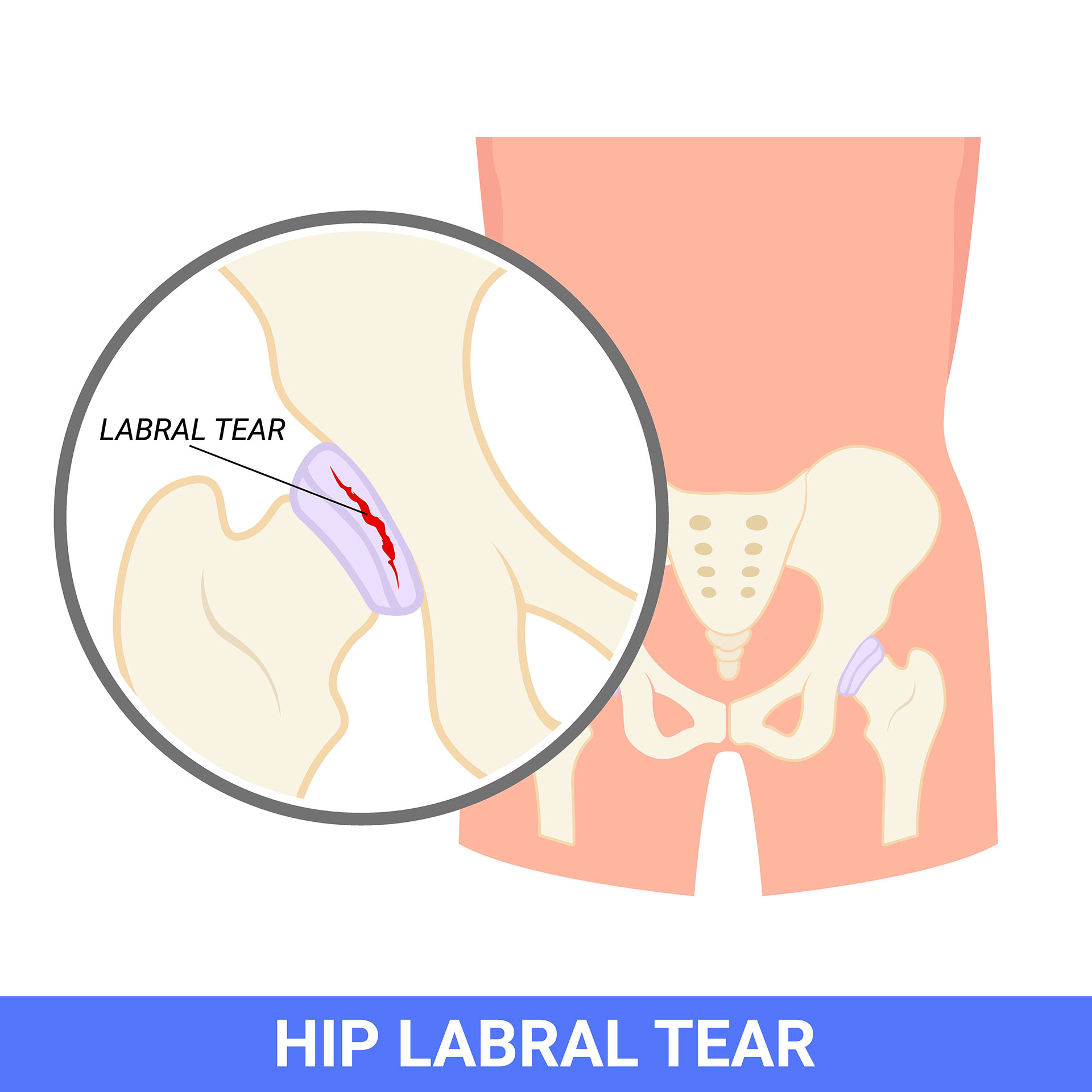 Hip Labral Tears