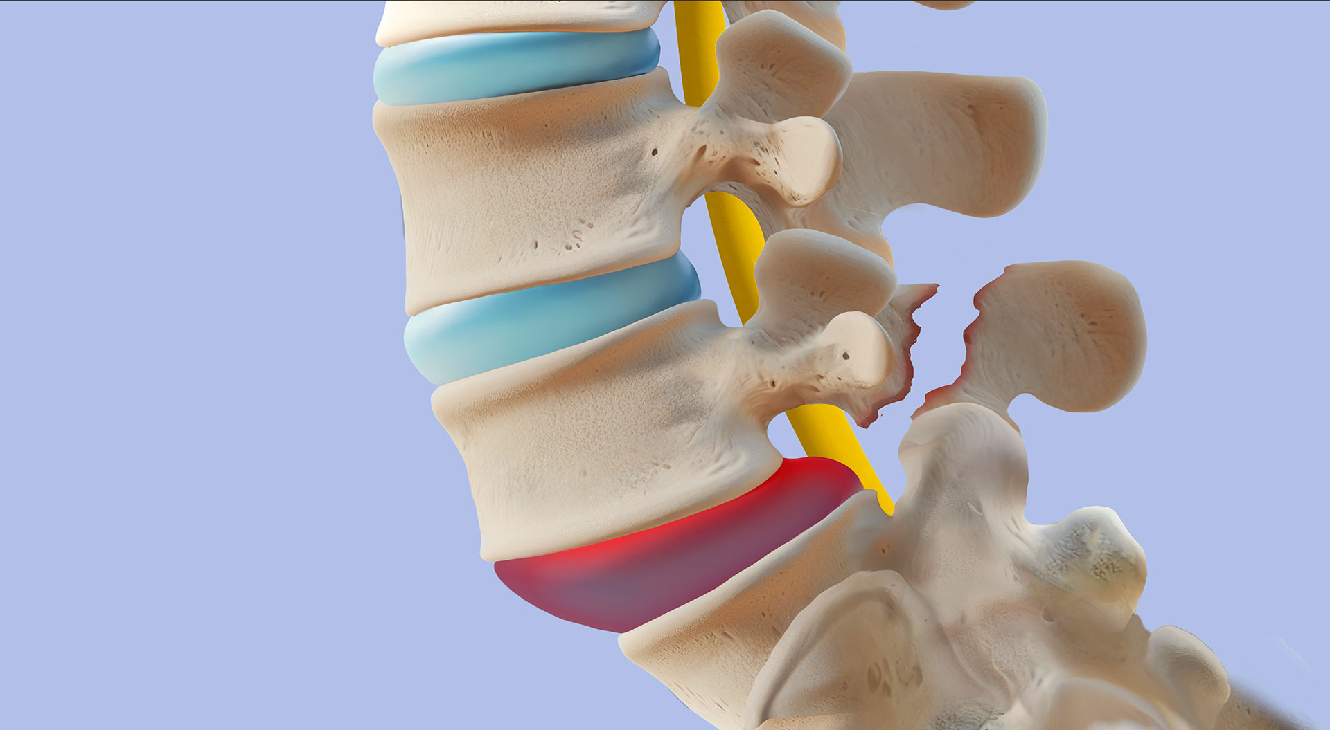 Spondylothesis