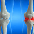 How to Get Rid of Knee Pain Fast? What Actually Works