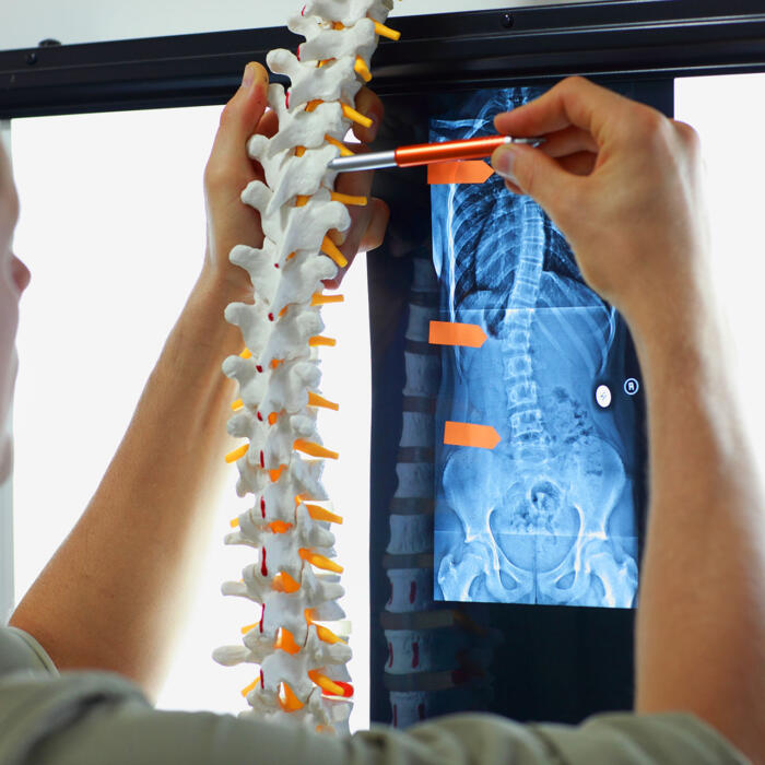 Physician pointing to spine model beside patient x-ray images